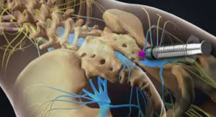 Epidural Treatment Lumber / Caudal