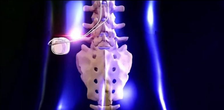 Spinal Cord Stimulation