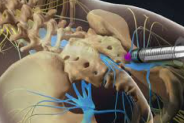 Epidural Treatment Lumber / Caudal