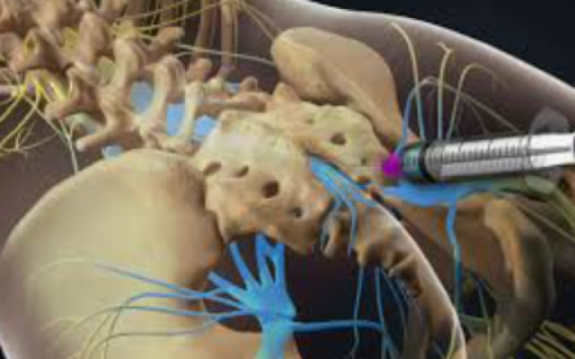 Epidural Treatment Lumber / Caudal