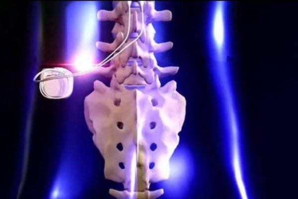 Spinal Cord Stimulation