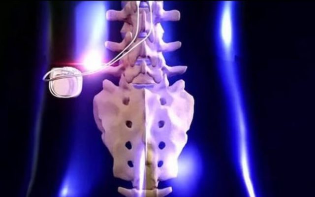 Spinal Cord Stimulation